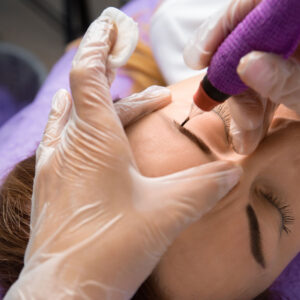 MICRO NEEDLING -£110.00