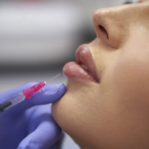 Lip Flip with Botox - £100.00