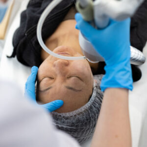 MICRO NEEDLING WITH EXOSOMES - £165.00